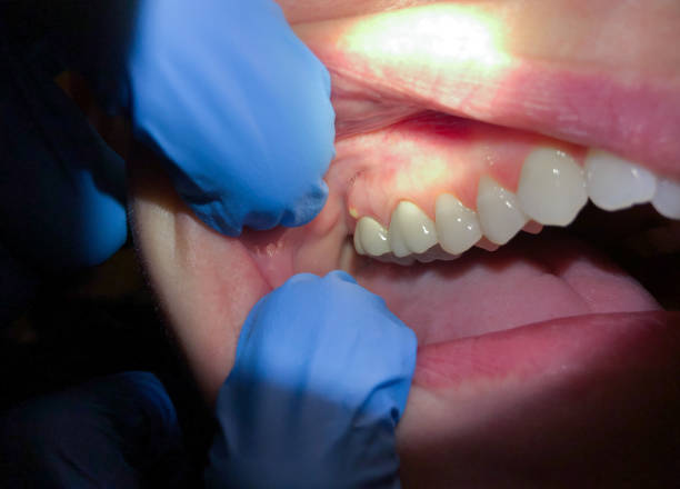 Tooth Infection Emergency Dentist in MN